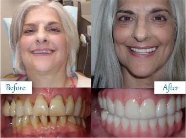 Before and after smile transformation showing improved teeth with cosmetic dentistry