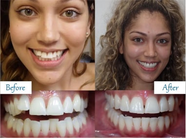 Before and after cosmetic dental work showcasing improved tooth alignment and color