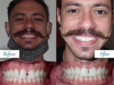 Cosmetic dental work before and after with bright, straight teeth and enhanced smile